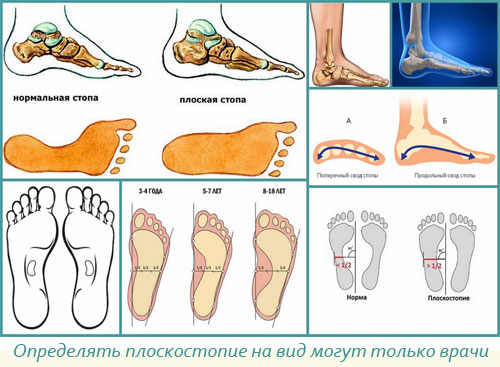 Виды плоскостопия