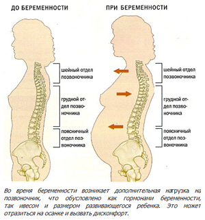 Боли в спине при беременности
