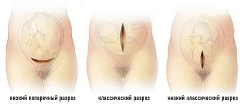 Кесарево сечение: за и против
