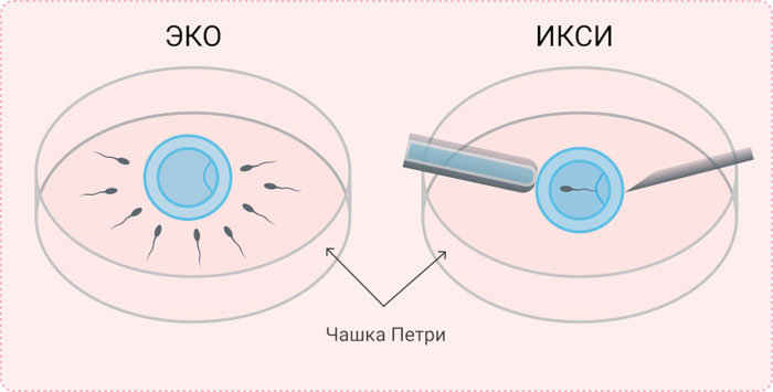 Что нужно знать об экстракорпоральном оплодотворении (ЭКО)