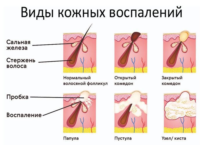 Прыщи: причины и методы избавления