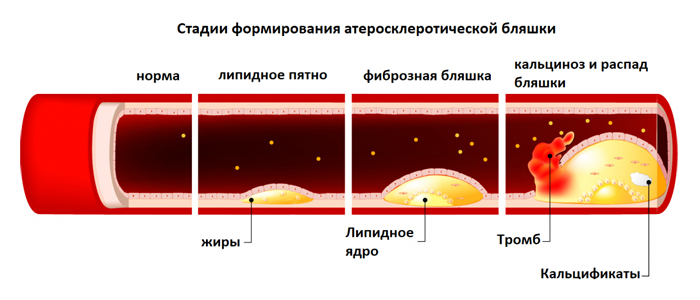 Почему нужно проверять липидный профиль крови